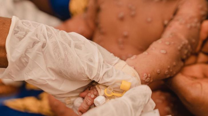 Primera vacuna contra el mpox: Más de 100.000 casos en todo el mundo